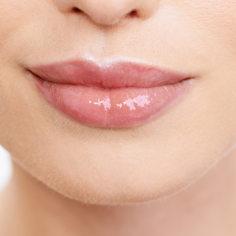 Lip Augmentation