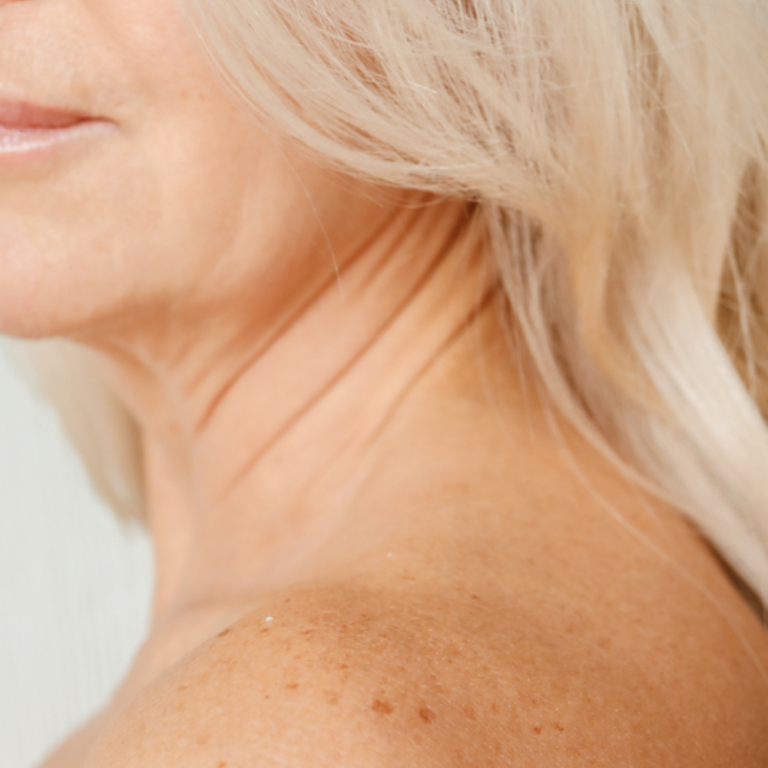 Sun Damage and Dark Spots